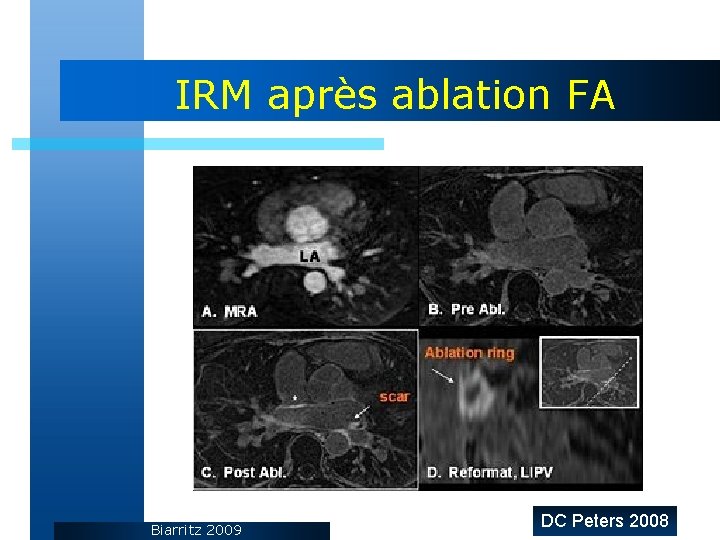 IRM après ablation FA Biarritz 2009 DC Peters 2008 