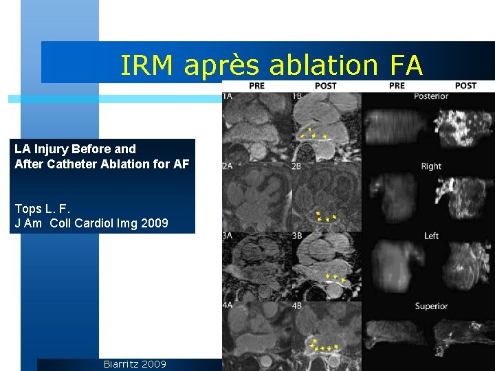 IRM après ablation FA LA Injury Before and After Catheter Ablation for AF Tops