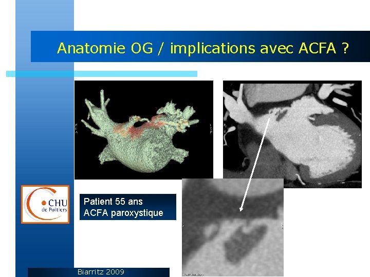 Anatomie OG / implications avec ACFA ? Patient 55 ans ACFA paroxystique Biarritz 2009