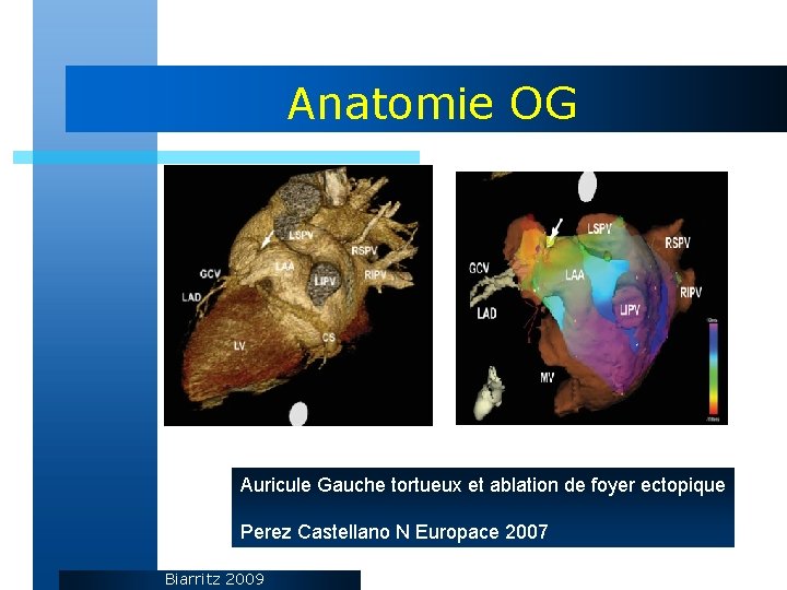 Anatomie OG Auricule Gauche tortueux et ablation de foyer ectopique Perez Castellano N Europace