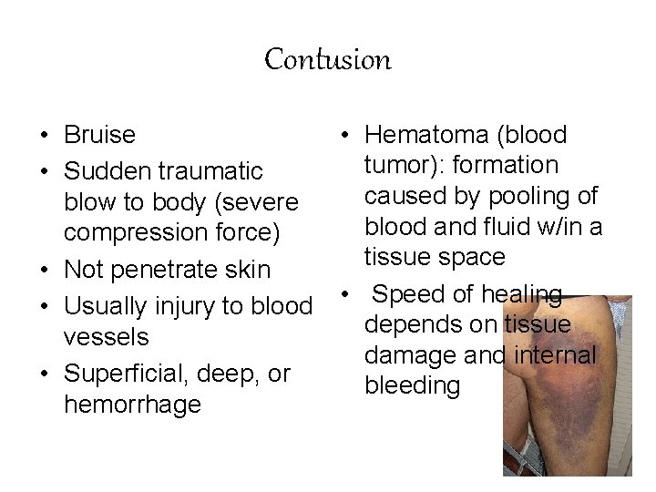 Contusion • Bruise • Sudden traumatic blow to body (severe compression force) • Not
