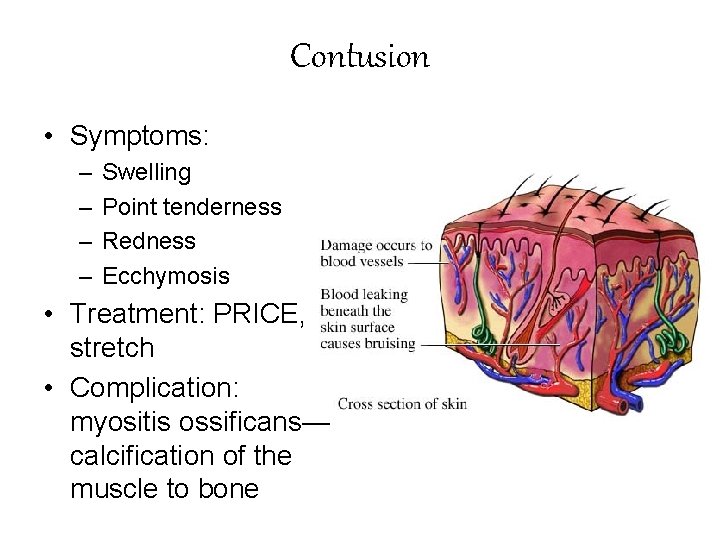 Contusion • Symptoms: – – Swelling Point tenderness Redness Ecchymosis • Treatment: PRICE, stretch