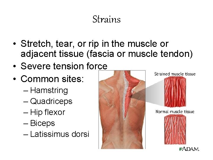 Strains • Stretch, tear, or rip in the muscle or adjacent tissue (fascia or