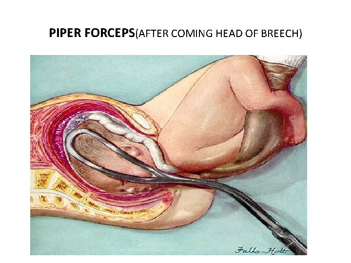 PIPER FORCEPS(AFTER COMING HEAD OF BREECH) 