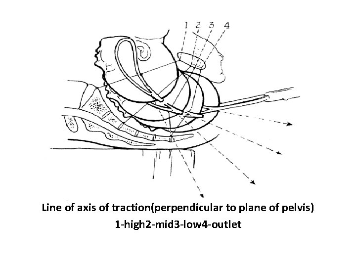 Line of axis of traction(perpendicular to plane of pelvis) 1 -high 2 -mid 3