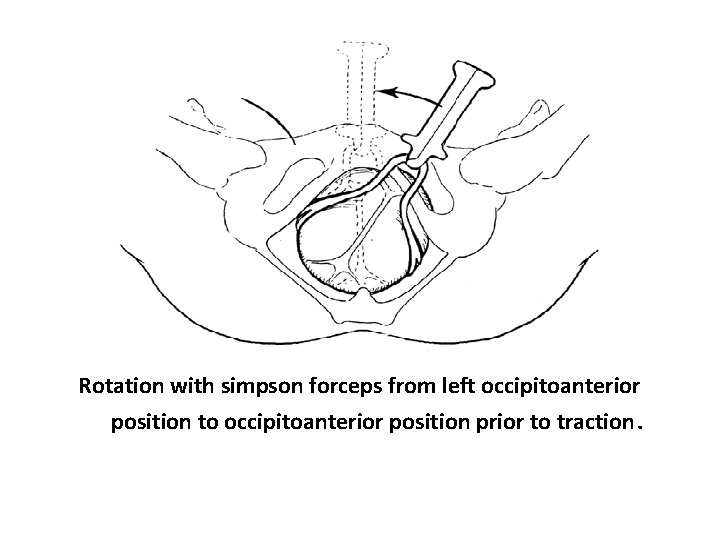 Rotation with simpson forceps from left occipitoanterior position to occipitoanterior position prior to traction.