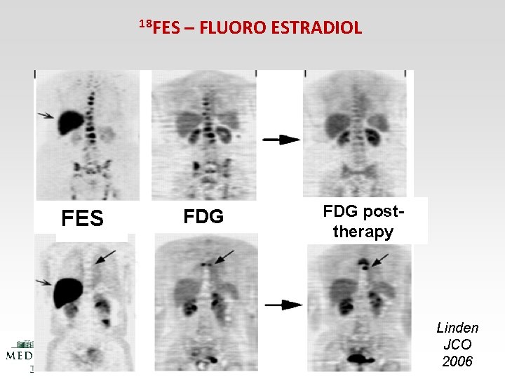 18 FES – FLUORO ESTRADIOL FDG posttherapy Linden JCO 2006 18 FES – FLUORO ESTRADIOL FDG posttherapy Linden JCO 2006