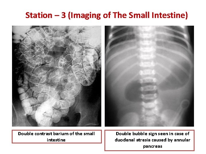 Station – 3 (Imaging of The Small Intestine) Double contrast barium of the small