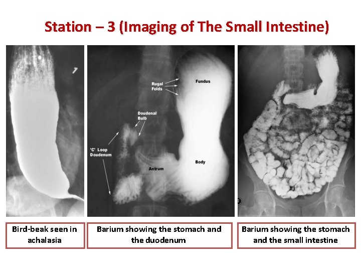 Station – 3 (Imaging of The Small Intestine) Bird-beak seen in achalasia Barium showing