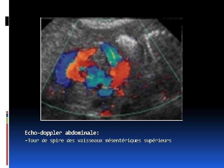 Echo-doppler abdominale: -Tour de spire des vaisseaux mésentériques supérieurs 