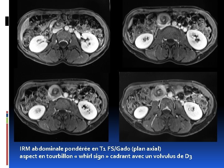 IRM abdominale pondérée en T 1 FS/Gado (plan axial) aspect en tourbillon « whirl