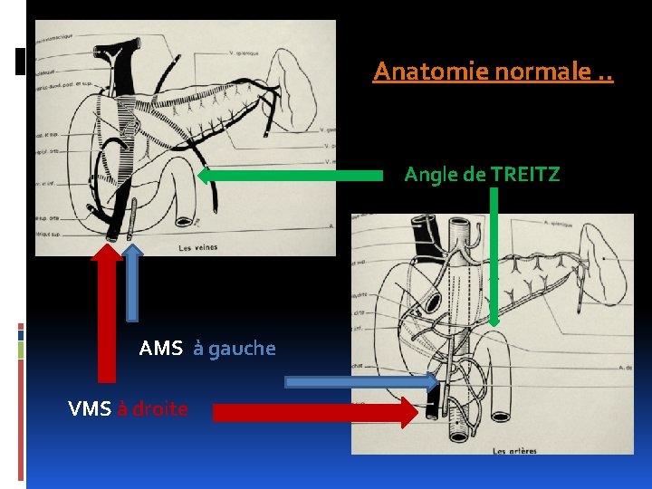 Anatomie normale. . Angle de TREITZ AMS à gauche VMS à droite 