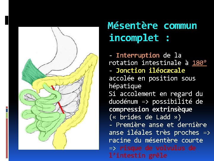Mésentère commun incomplet : - Interruption de la rotation intestinale à 180° - Jonction