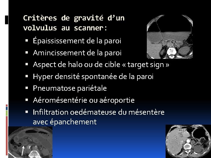 Critères de gravité d’un volvulus au scanner: Épaississement de la paroi Amincissement de la