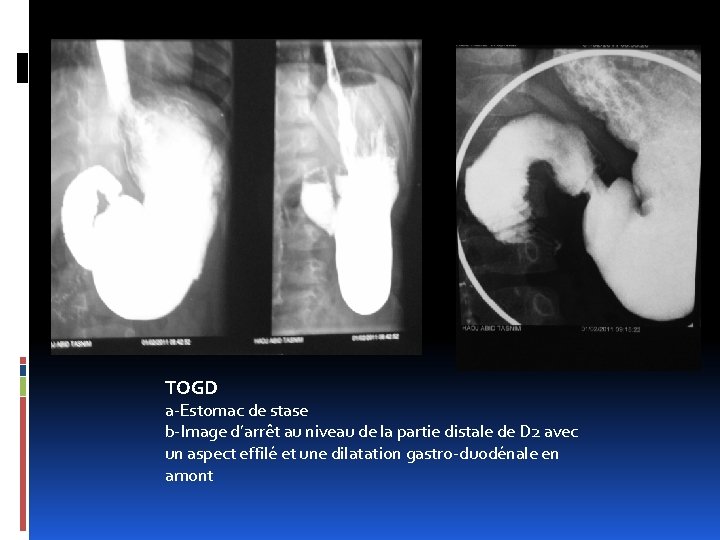 TOGD a-Estomac de stase b-Image d’arrêt au niveau de la partie distale de D