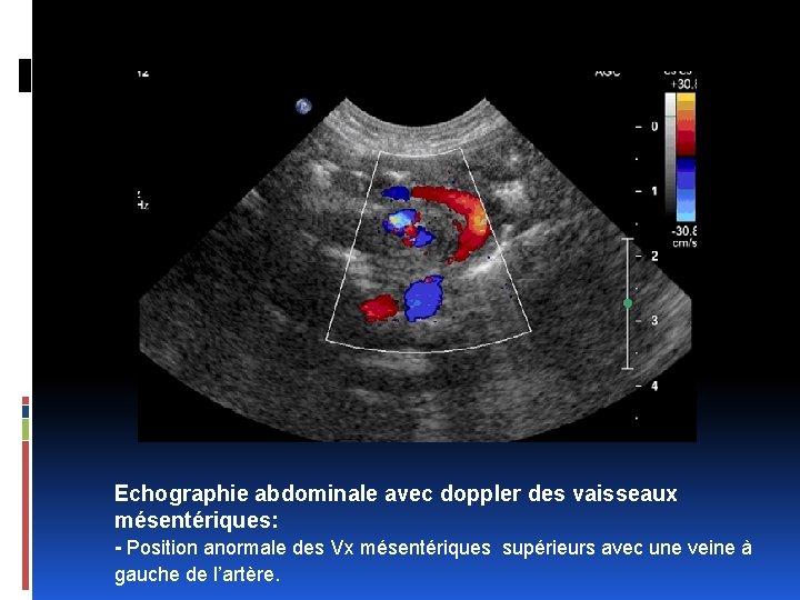 Echographie abdominale avec doppler des vaisseaux mésentériques: - Position anormale des Vx mésentériques supérieurs