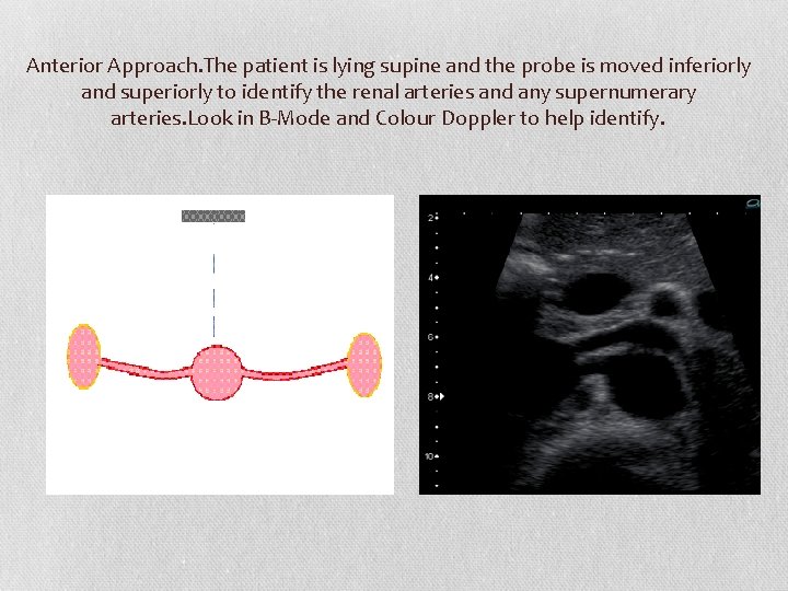 Anterior Approach. The patient is lying supine and the probe is moved inferiorly and