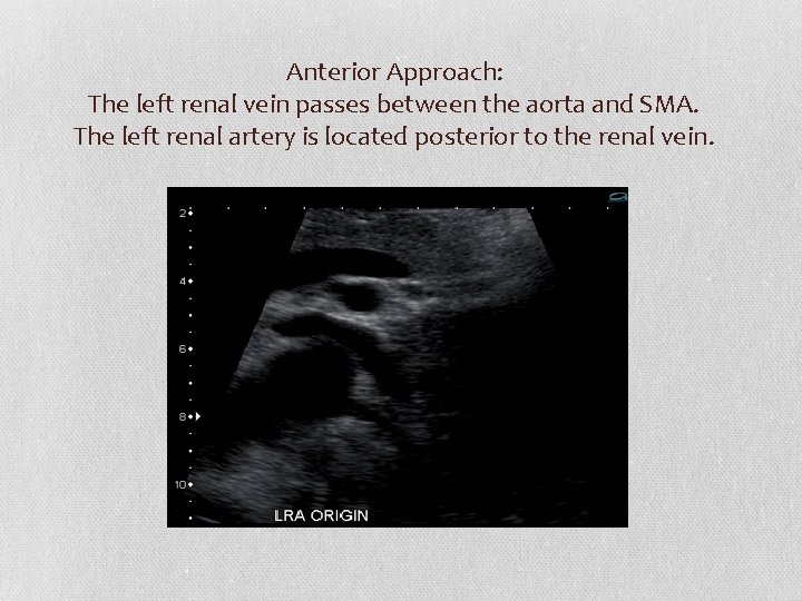 Anterior Approach: The left renal vein passes between the aorta and SMA. The left