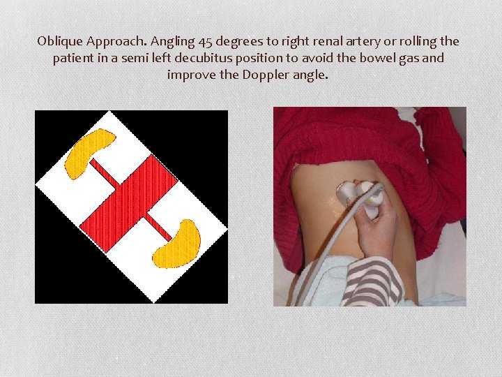 Oblique Approach. Angling 45 degrees to right renal artery or rolling the patient in