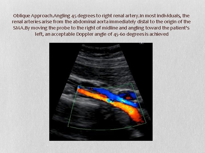 Oblique Approach. Angling 45 degrees to right renal artery. In most individuals, the renal
