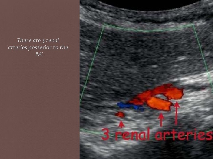 There are 3 renal arteries posterior to the IVC 