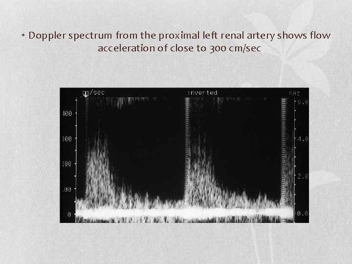  • Doppler spectrum from the proximal left renal artery shows flow acceleration of
