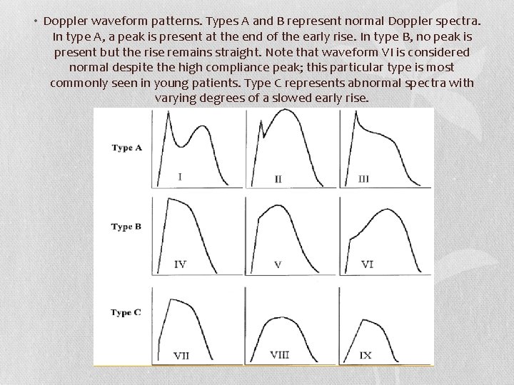  • Doppler waveform patterns. Types A and B represent normal Doppler spectra. In