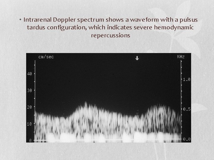  • Intrarenal Doppler spectrum shows a waveform with a pulsus tardus configuration, which