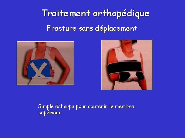 Traitement orthopédique Fracture sans déplacement Simple écharpe pour soutenir le membre supérieur 