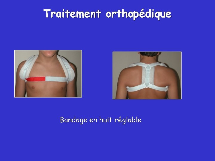 Traitement orthopédique Bandage en huit réglable 