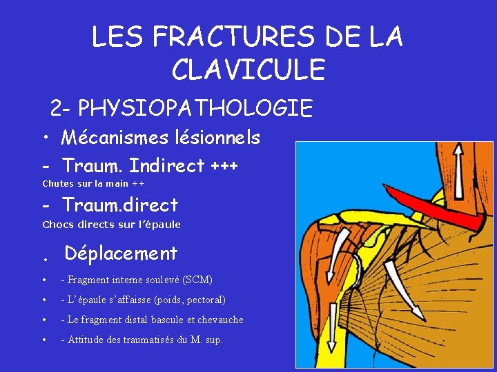 LES FRACTURES DE LA CLAVICULE 2 - PHYSIOPATHOLOGIE • Mécanismes lésionnels - Traum. Indirect