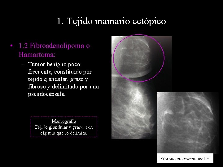 1. Tejido mamario ectópico • 1. 2 Fibroadenolipoma o Hamartoma: – Tumor benigno poco