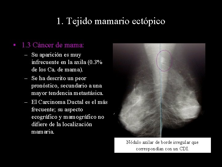 1. Tejido mamario ectópico • 1. 3 Cáncer de mama: – Su aparición es