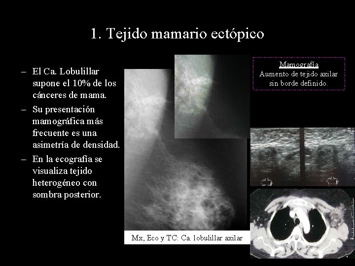 1. Tejido mamario ectópico Mamografía Aumento de tejido axilar sin borde definido. – El