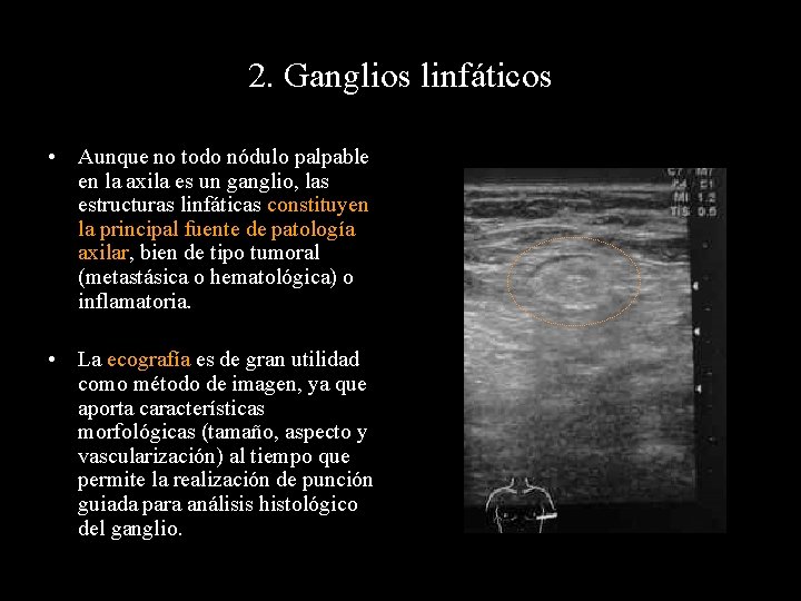 2. Ganglios linfáticos • Aunque no todo nódulo palpable en la axila es un