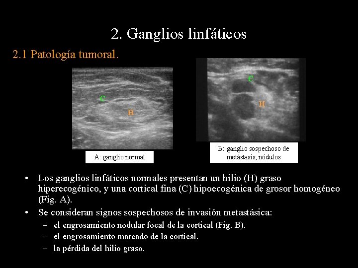 2. Ganglios linfáticos 2. 1 Patología tumoral. C C H H A: ganglio normal