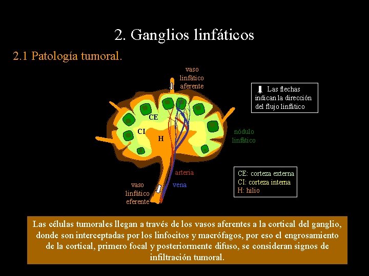 2. Ganglios linfáticos 2. 1 Patología tumoral. vaso linfático aferente Las flechas indican la