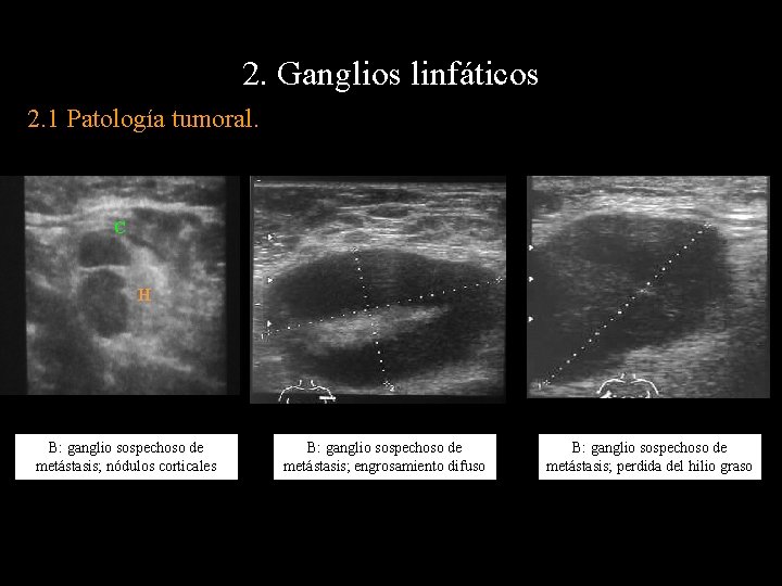 2. Ganglios linfáticos 2. 1 Patología tumoral. C H B: ganglio sospechoso de metástasis;