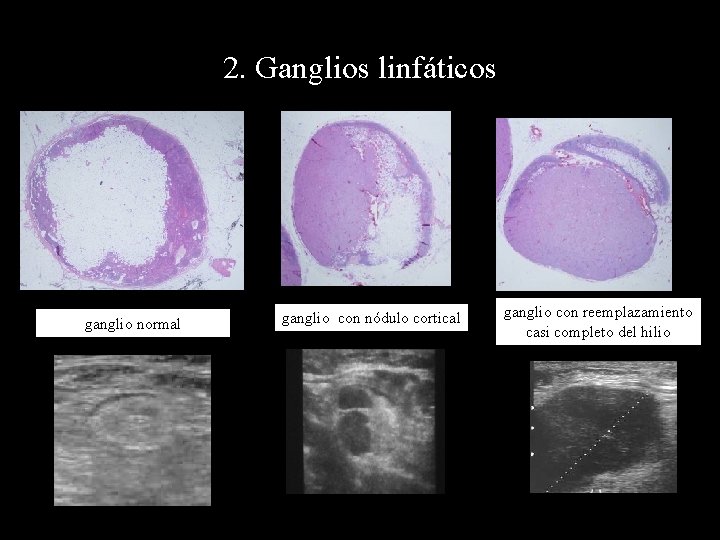 2. Ganglios linfáticos ganglio normal ganglio con nódulo cortical ganglio con reemplazamiento casi completo