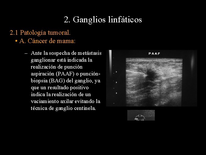 2. Ganglios linfáticos 2. 1 Patología tumoral. • A. Cáncer de mama: – Ante