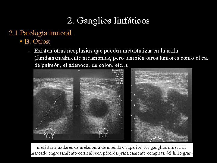 2. Ganglios linfáticos 2. 1 Patología tumoral. • B. Otros: – Existen otras neoplasias