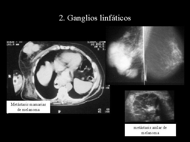 2. Ganglios linfáticos Metástasis mamarias de melanoma metástasis axilar de melanoma 