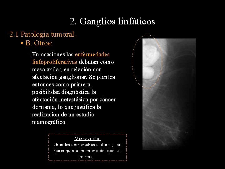 2. Ganglios linfáticos 2. 1 Patología tumoral. • B. Otros: – En ocasiones las