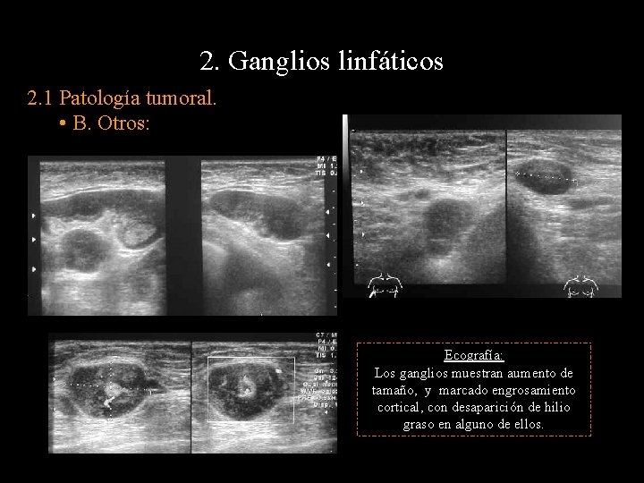 2. Ganglios linfáticos 2. 1 Patología tumoral. • B. Otros: Ecografía: Los ganglios muestran