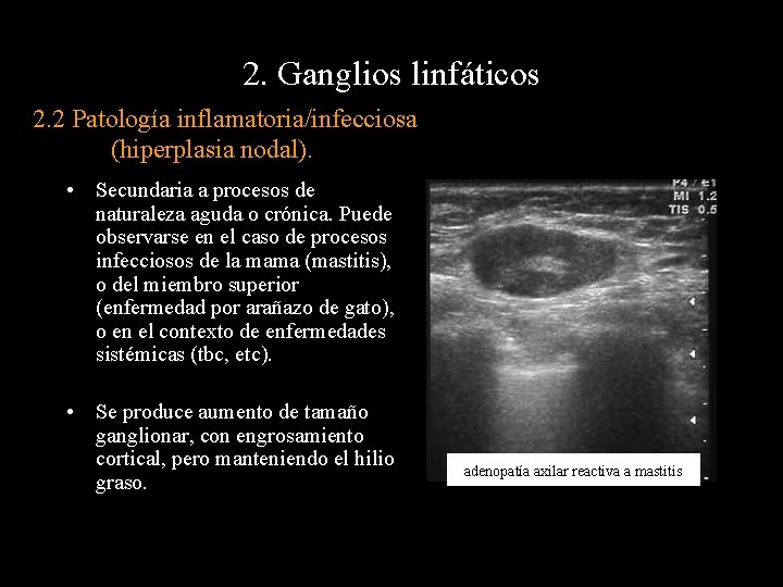 2. Ganglios linfáticos 2. 2 Patología inflamatoria/infecciosa (hiperplasia nodal). • Secundaria a procesos de