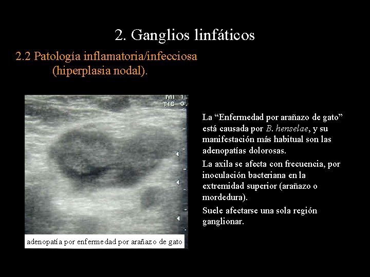 2. Ganglios linfáticos 2. 2 Patología inflamatoria/infecciosa (hiperplasia nodal). La “Enfermedad por arañazo de