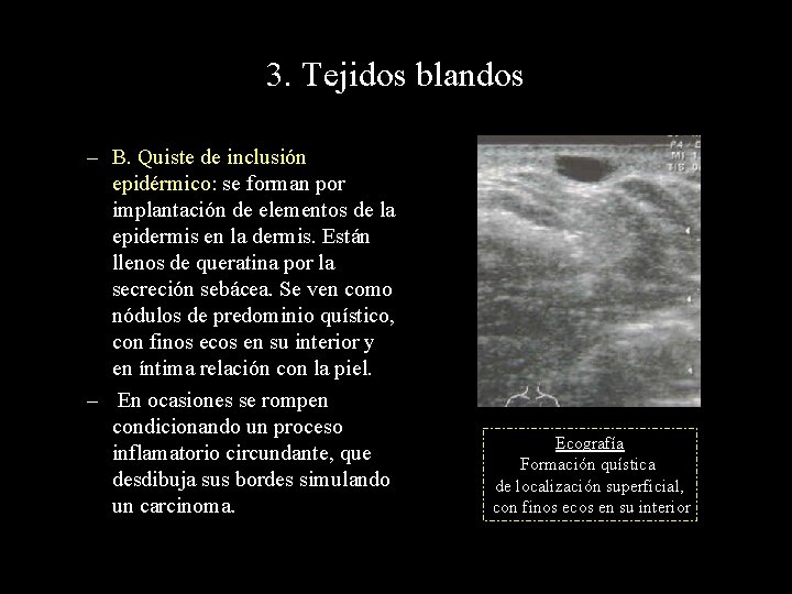 3. Tejidos blandos – B. Quiste de inclusión epidérmico: se forman por implantación de