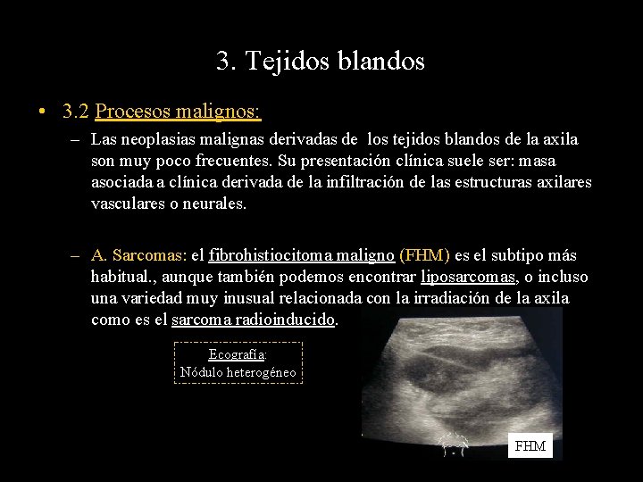 3. Tejidos blandos • 3. 2 Procesos malignos: – Las neoplasias malignas derivadas de