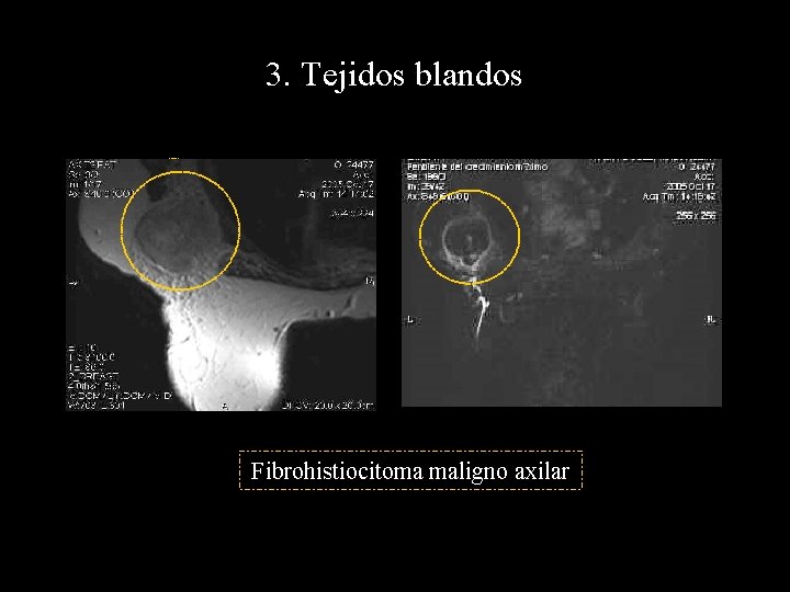 3. Tejidos blandos Fibrohistiocitoma maligno axilar 