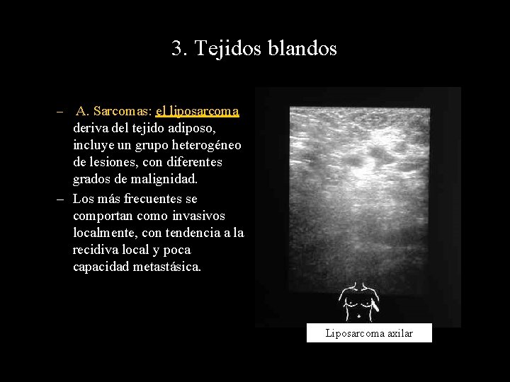 3. Tejidos blandos – A. Sarcomas: el liposarcoma deriva del tejido adiposo, incluye un